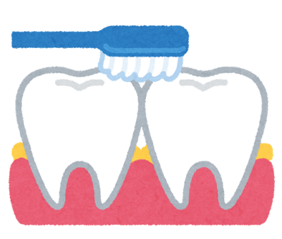  歯間部の歯垢のイラスト