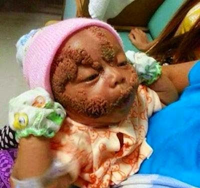 Cananglahnie: Muka Bayi Bengkak Kerana Serangan Semut Charlie
