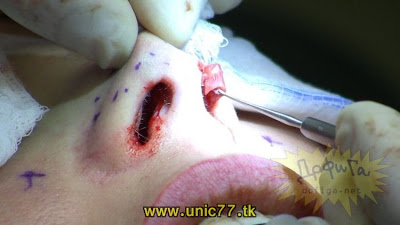proses pembedahan plastik pada muka