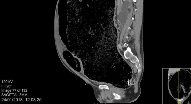 Doença leva à ruptura de intestino devido a excesso de fezes