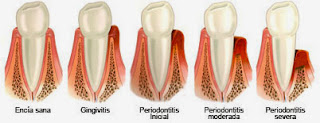 periodontitis