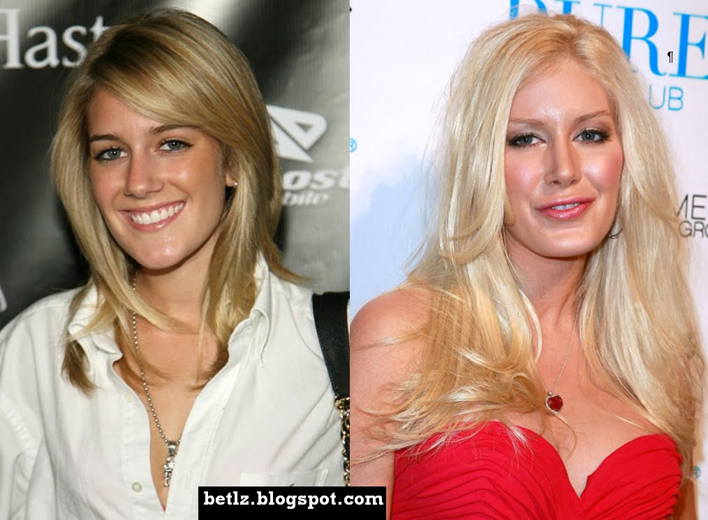 heidi montag after surgery photos. heidi montag after surgery.