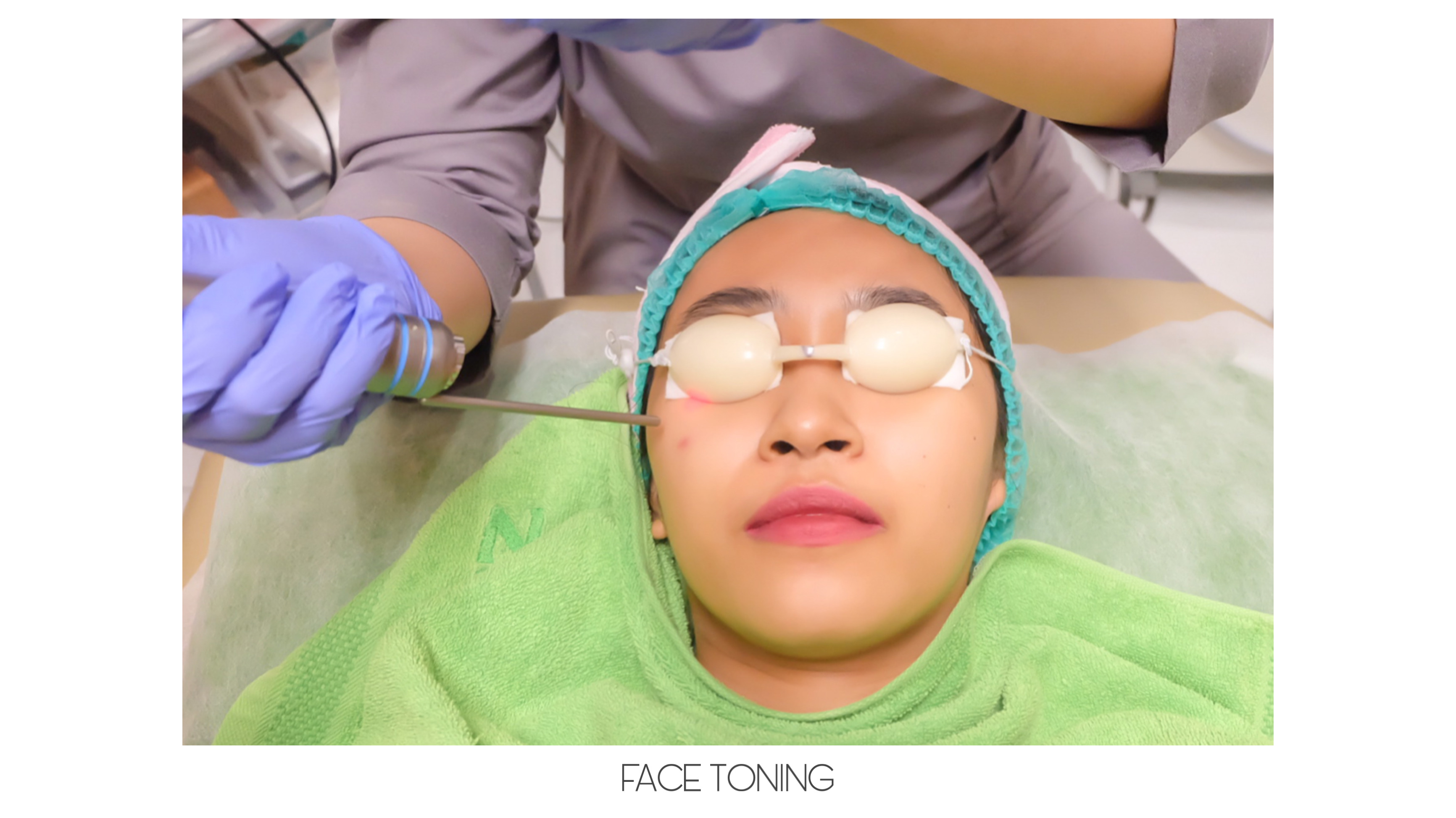 [Review] Treatement Diamond Peel dan Photo Facial Glow di ZAP Clinic