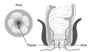 Analna fisura je oštećenje ili pukotina u sluzokoži analnog kanala ili na samom izlazu anusa.