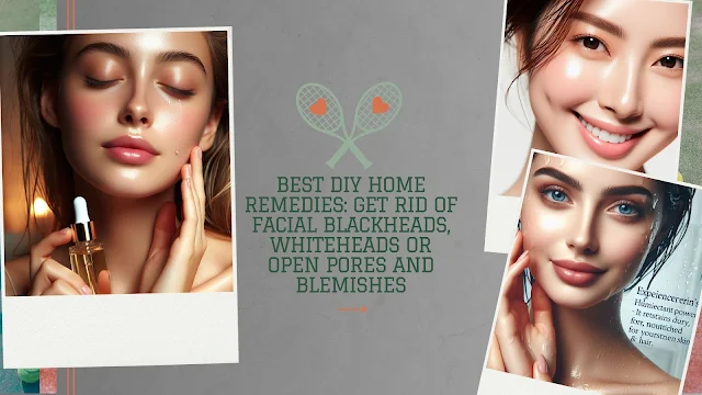 Best DIY Home Remedies: Get Rid of Facial Blackheads, Whiteheads or Open Pores and Blemishes