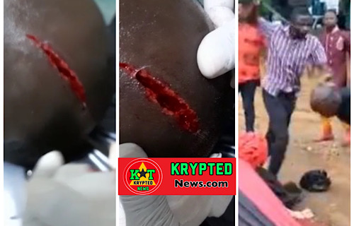 WATCH VIDEO: Suhum Npp Clash - Watch Video Of Man Who Was Slashed In The Head 
