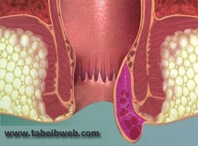 شكل البواسير الخارجية بالصور الطبيعية 