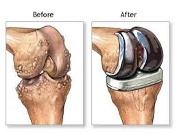Total Knee Replacement Surgery Delhi