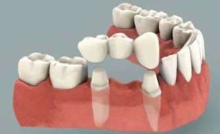 Biaya dan Harga Gigi Palsu dan Pasangnya yang Bagus dan Murah serta Jenis-Jenisnya