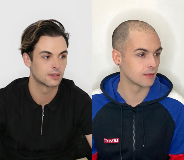 Union J Jaymi Hensley ha trasformato il suo look dopo trapianto di capelli