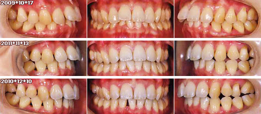 歯列矯正：定期検診その4