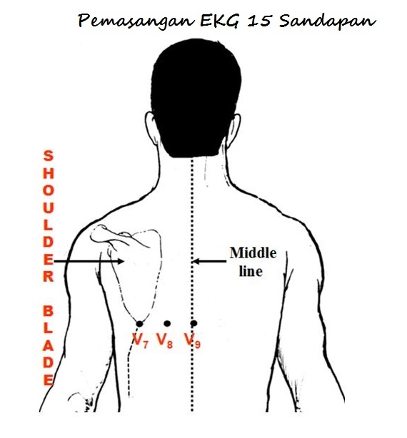Begini Pemasangan  EKG  15 Sandapan Dan EKG  12 Sandapan Sisi 