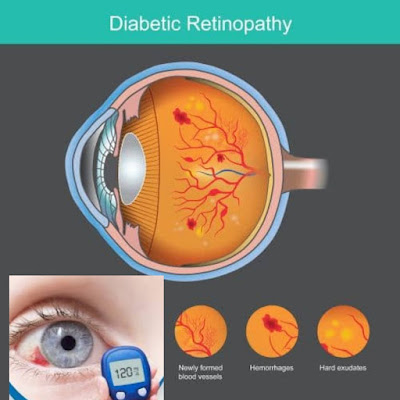 اعتلال الشبكية السكري  diabetic retinopathy