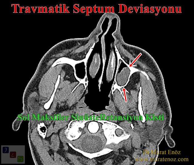 Travmatik septum deviasyonu - Travmatik septum deviasyonu tedavisi - Travmatik burun septumunda eğrilme - Travmatik nazal septum kırığı - Nazal septum deviasyonu tedavisi - Burunda kemik spur formasyonu