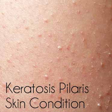 Keratosis Pilaris (Bumps on Skin) - Chronicles of a 