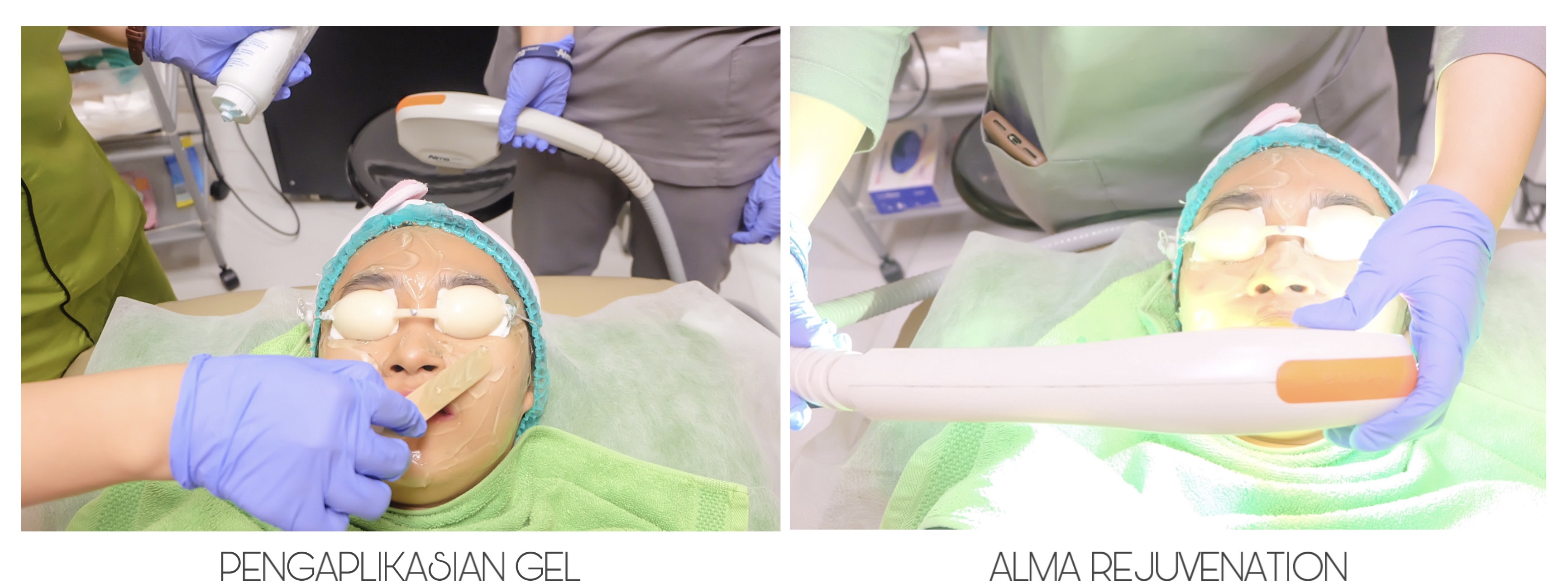 [Review] Treatement Diamond Peel dan Photo Facial Glow di ZAP Clinic