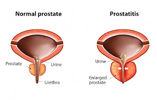 gambar penyakit prostatitis