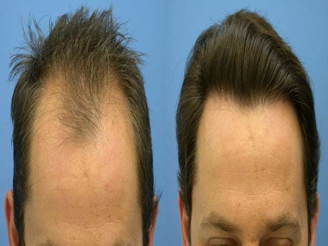 best hair transplant in lahore