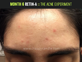 Month 6 on Retin-A :: The Acne Experiment