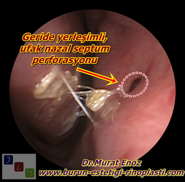 Septum perforasyonu tanımı - Septum perforasyonu  nedenleri - Septum perforasyonu belirtileri - Septum perforasyonu tedavisi - Açık teknik septum perforasyonu ameliyatı - Açık teknik septum perforasyonu onarımı - Burun duvarında delik