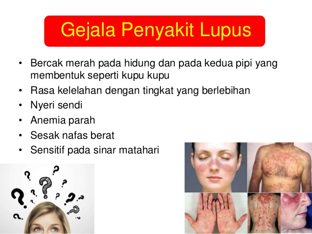 gejala penyakit lupus