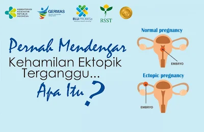 PPK Obgyn Tentang Kehamilan Ektopik Terganggu