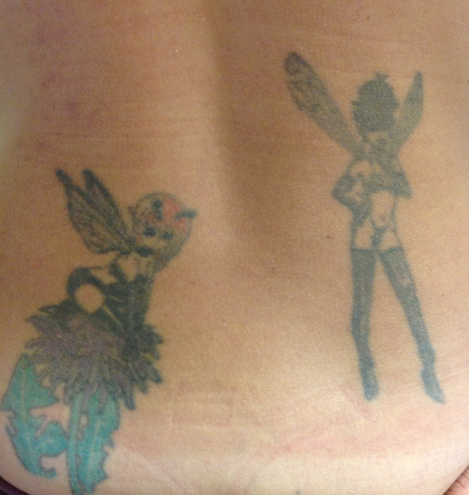 My tattoo removal process: Day 1: My tattoos before and after my first ...