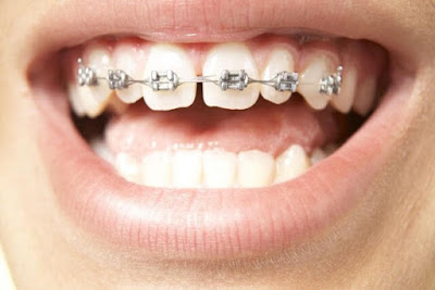 Kỹ thuật niềng răng thưa là như thế nào?