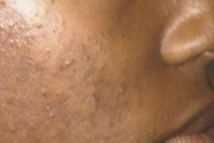 Treatment for post inflammatory hyperpigmentation black skin