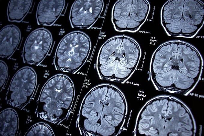 Estudo de ressonância magnética destaca impacto de COVID longo no cérebro