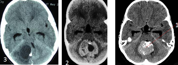 abnormal mri brain