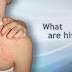 Hives (urticaria): Causes, pictures, treatments, and symptoms