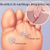 Home Remedies for Foot Allergy ( Plantar Warts)