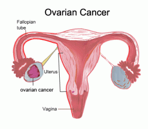 How to Know Symptoms, Types and Causes Ovarian Cancer? Women Must Read