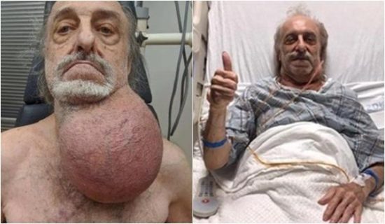 Idoso de 81 anos tem tumor de 23 cm retirado do pescoço