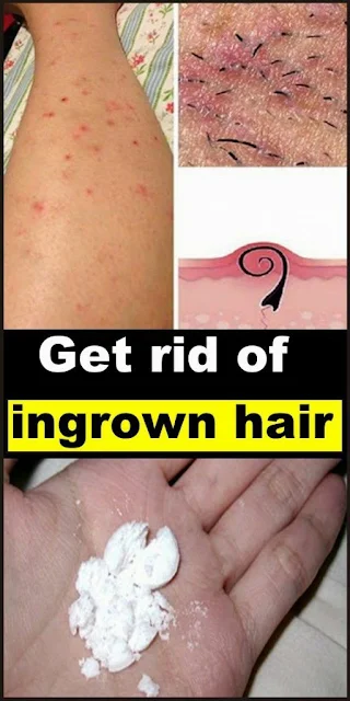 How to Get Rid of Ingrown Hair ?