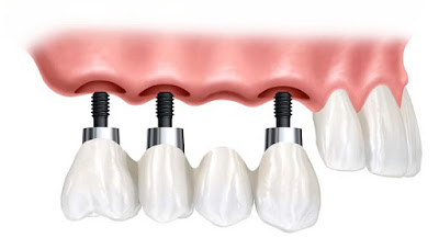Tiến hành trồng răng implant khi bị mất nhiều răng