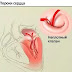 болезнь порок сердца