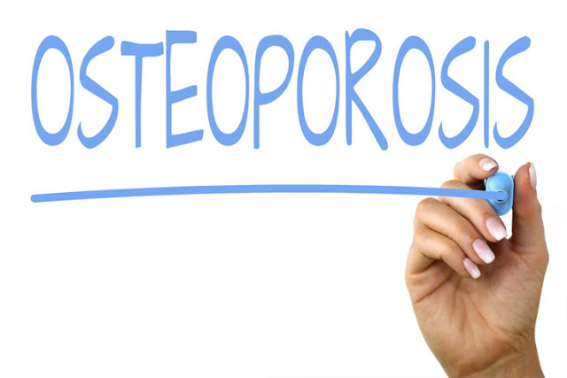 Osteoporosis adalah,osteoporosis adalah pdf,osteoporosis adalah penyakit tulang yg disebabkan oleh,osteoporosis adalah penyakit yang menyerang tts,osteoporosis adalah gejala,osteoporosis adalah penyakit tulang yang berupa,osteoporosis adalah kelainan tulang berupa,osteoporosis adalah kelainan tulang berupa pengeroposan tulang kelainan ini karena,osteoporosis adalah keadaan tulang menjadi rapuh dan keropos menurut anda apa penyebabnya,osteoporosis adalah penyakit akibat kekurangan brainly,osteoporosis adalah ppt,osteoporosis adalah penyakit yg menyerang tts,osteoporosis adalah penyakit yang menyerang,osteoporosis adalah brainly,osteoporosis adalah penyakit keroposnya tulang yang disebabkan tubuh kekurangan,osteoporosis adalah kelainan tulang,osteoporosis adalah kelainan tulang berupa brainly,osteoporosis adalah kekurangan,osteoporosis adalah jurnal,osteoporosis adalah kelainan pada,osteoporosis adalah penyakit yang menyerang bagian,osteoporosis adalah penyakit akibat kekurangan,osteoporosis adalah kelainan tulang akibat,anti osteoporosis adalah