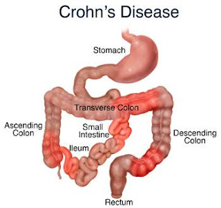 penyakit Crohn