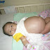 Subhanallah!! Bayi Mengandungkan Bayi Lain Dalam Perut 