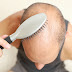 15 Tips गंजापन दूर करने के सरल उपचार. : How to fight against baldness?