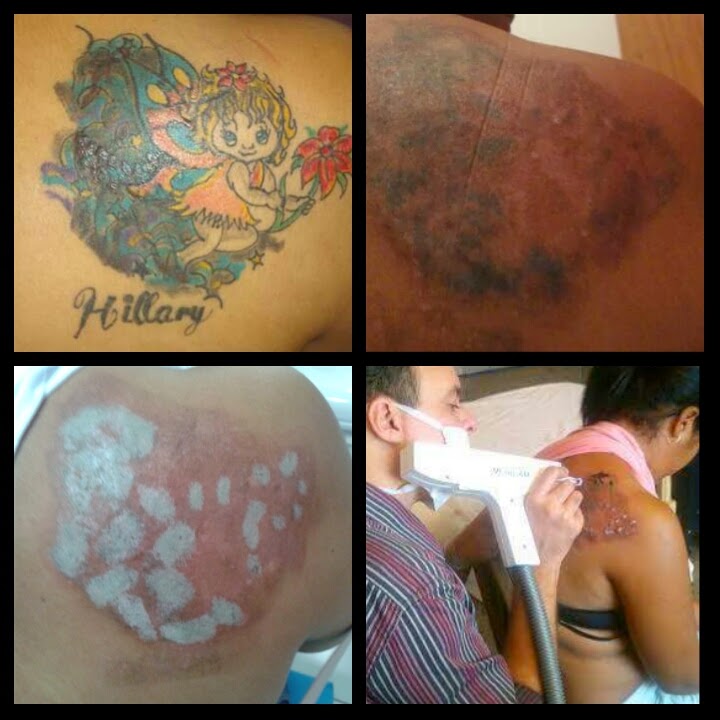 Imagens de remoção de tatuagem a laser antes e depois