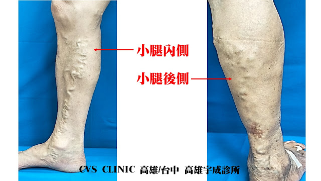 靜脈曲張, varicose vein, 適用手術的案例, 微創雷射手術, evla