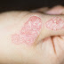 Những dấu hiệu ngoài da của bệnh vảy nến