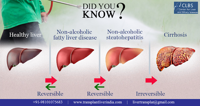 Reversal of Liver Cirrhosis