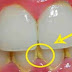 كيف تزيل رواسب الأسنان بسرعة ودون الذهاب إلى الطبيب!