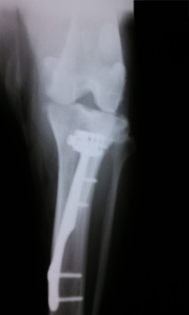 vista anteroposterior TTA en rotura del ligamento cruzado anterior de la rodilla