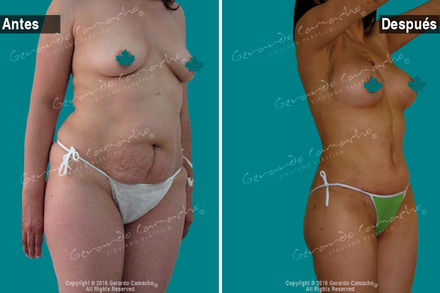 Mommy Makeover con Lipotransferencia Bogota  