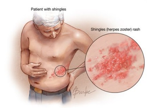 Cara Menghilangkan Varicella Sembuh Total